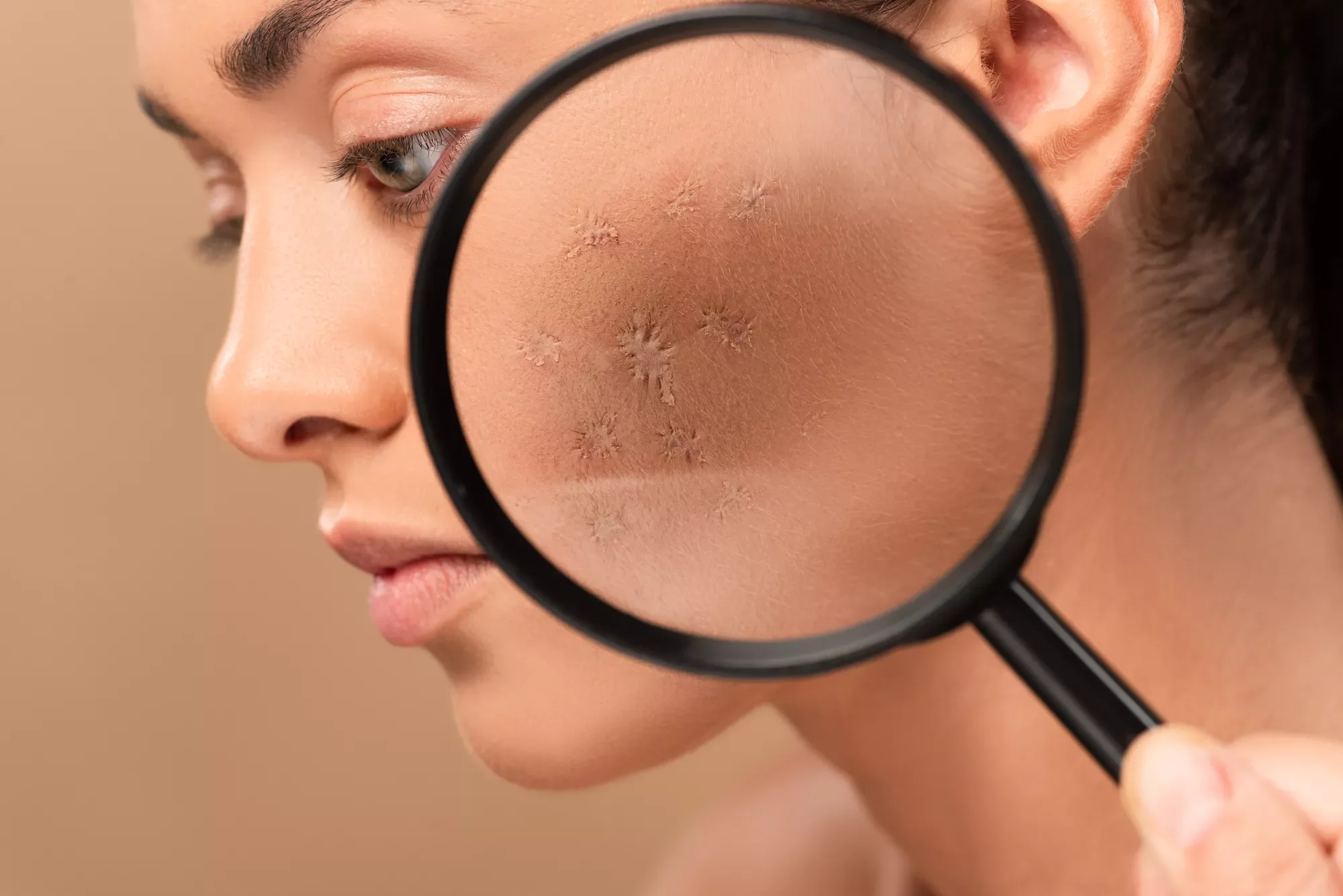 get rid of acne scars