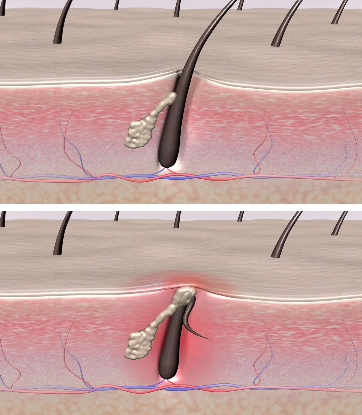 Illustration of an ingrown hair