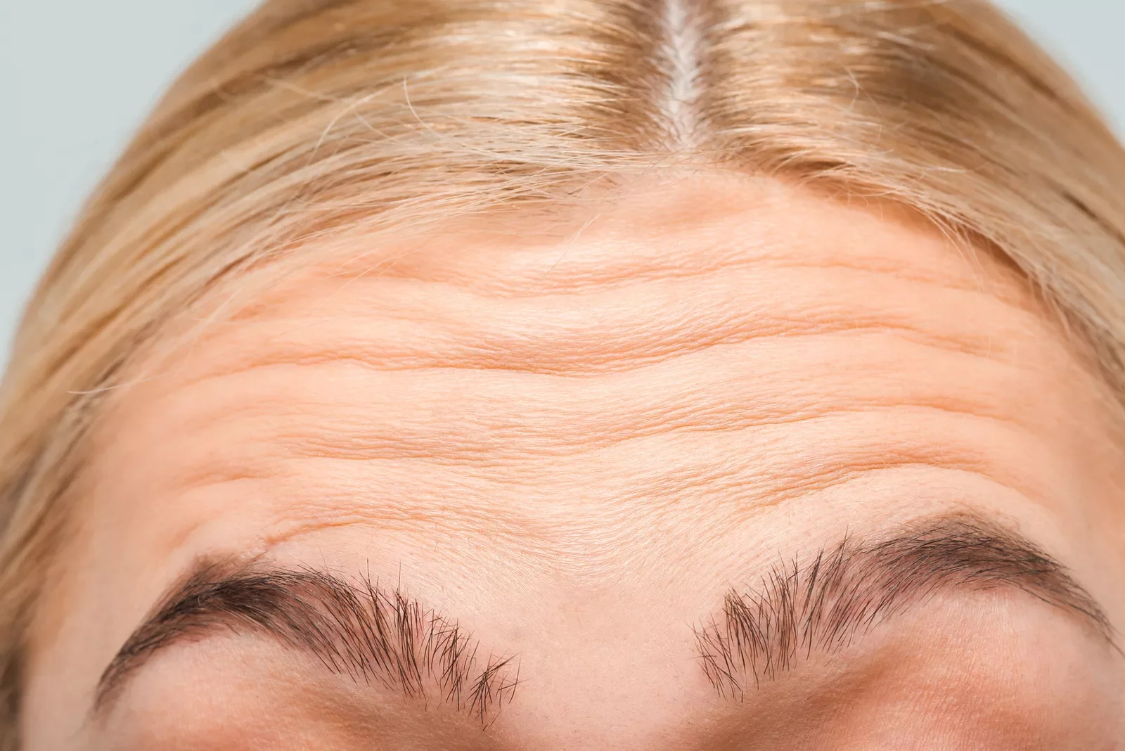Treatments for Forehead Wrinkles