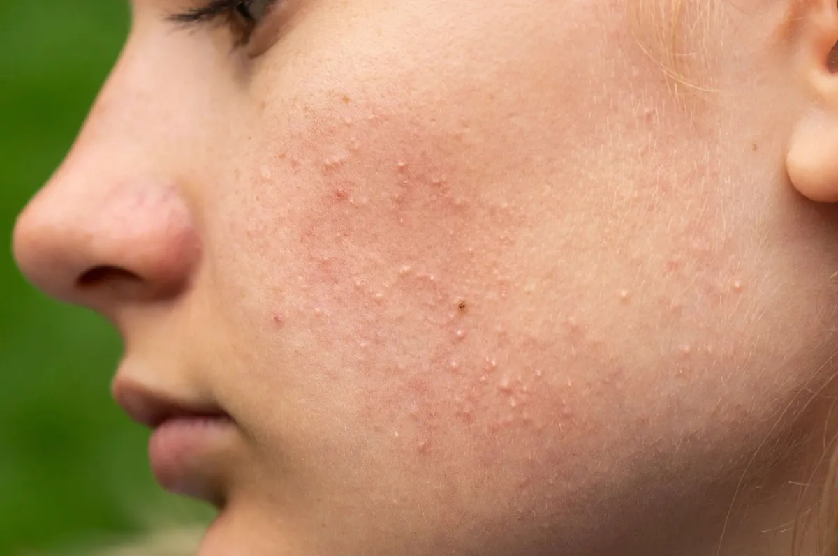 Close-up of a woman's face with bumps after a Brazilian wax