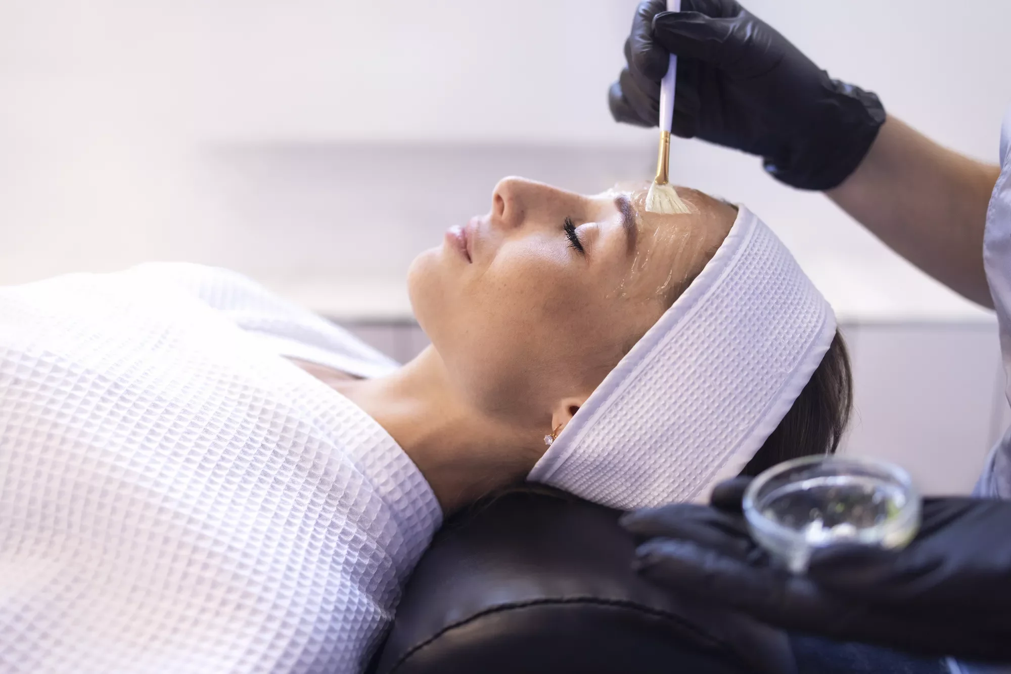 Chemical Peels for Renewed Radiance